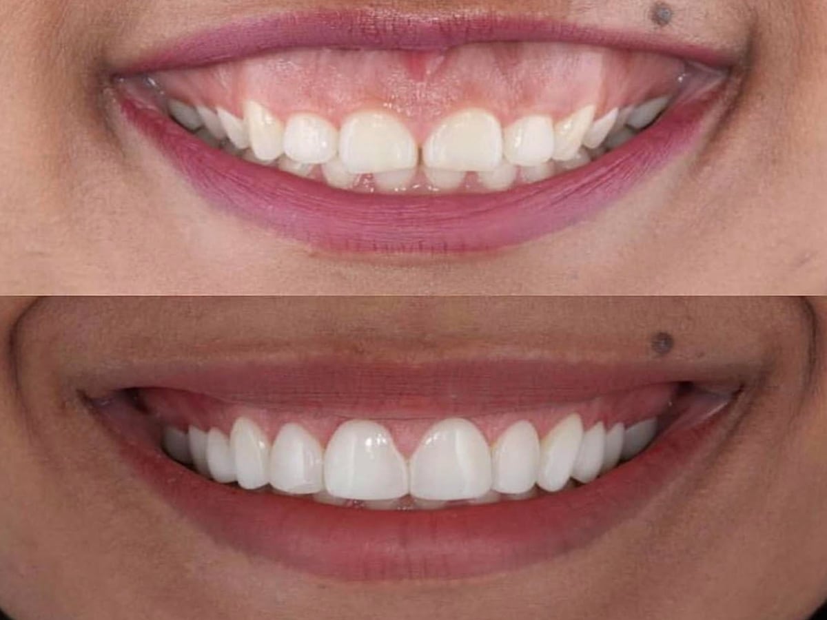 https://healthioturkey.com/wp-content/uploads/2024/01/gummy-smile-correction-gum-countrin-Indore.jpg
