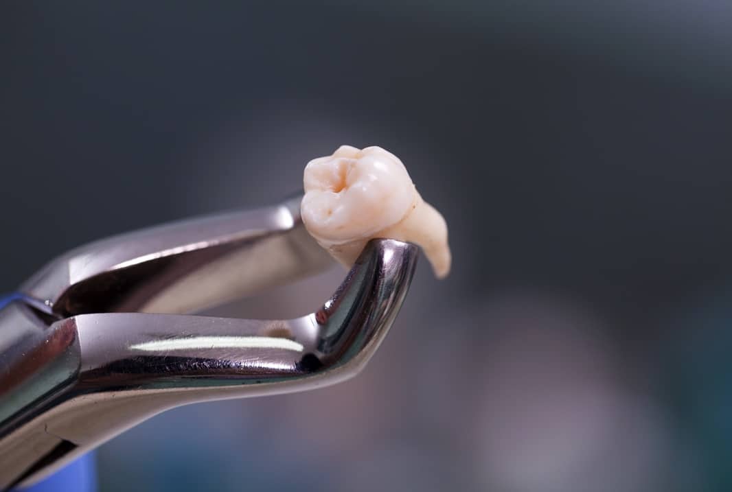 https://healthioturkey.com/wp-content/uploads/2024/01/tooth-extraction.jpeg