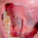 mouth cancer treatment