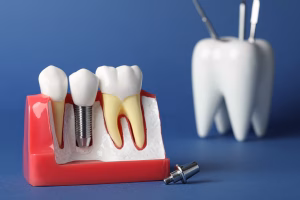 Why Dental Implant Antalya at Healthio is Better