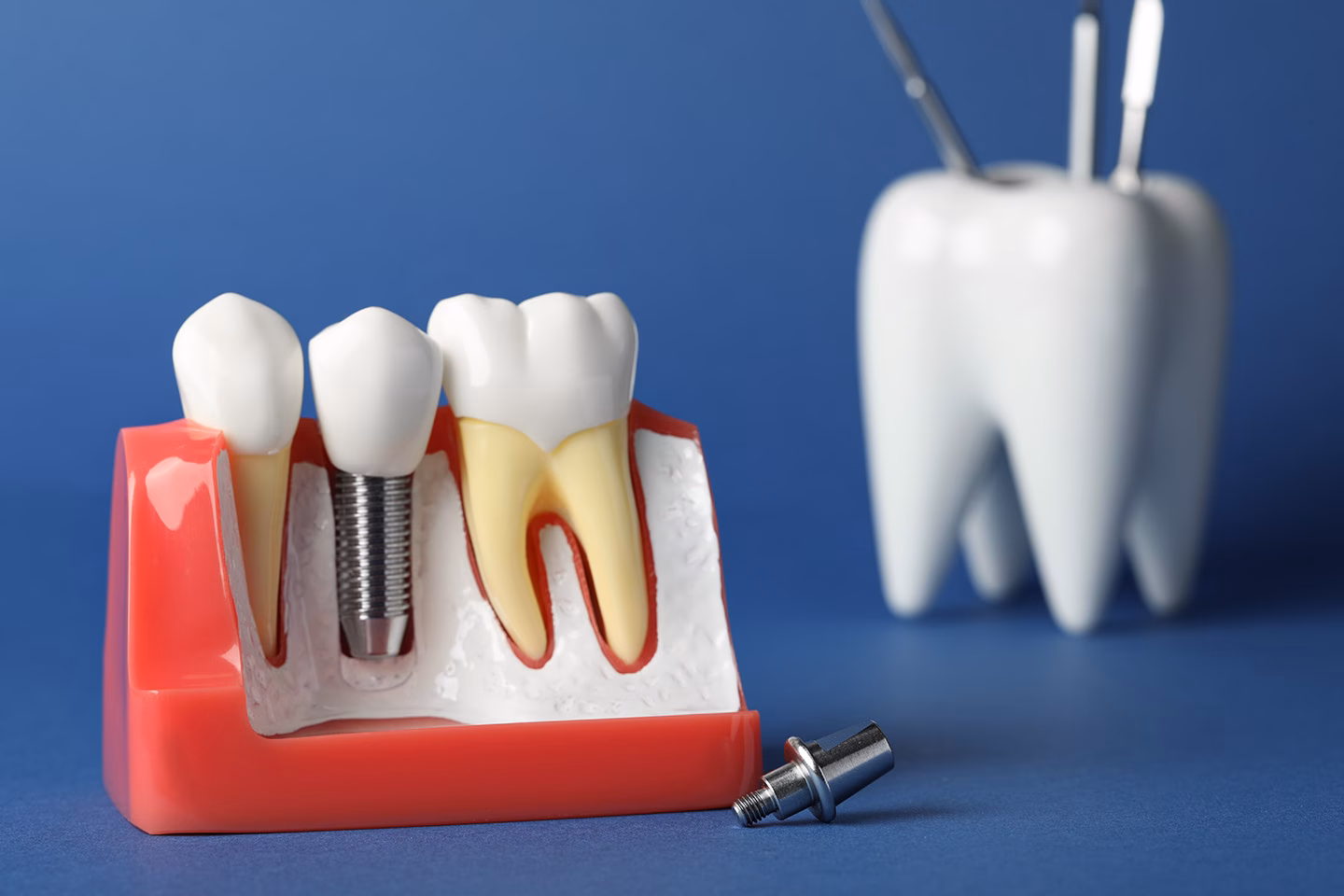 Why Dental Implant Antalya