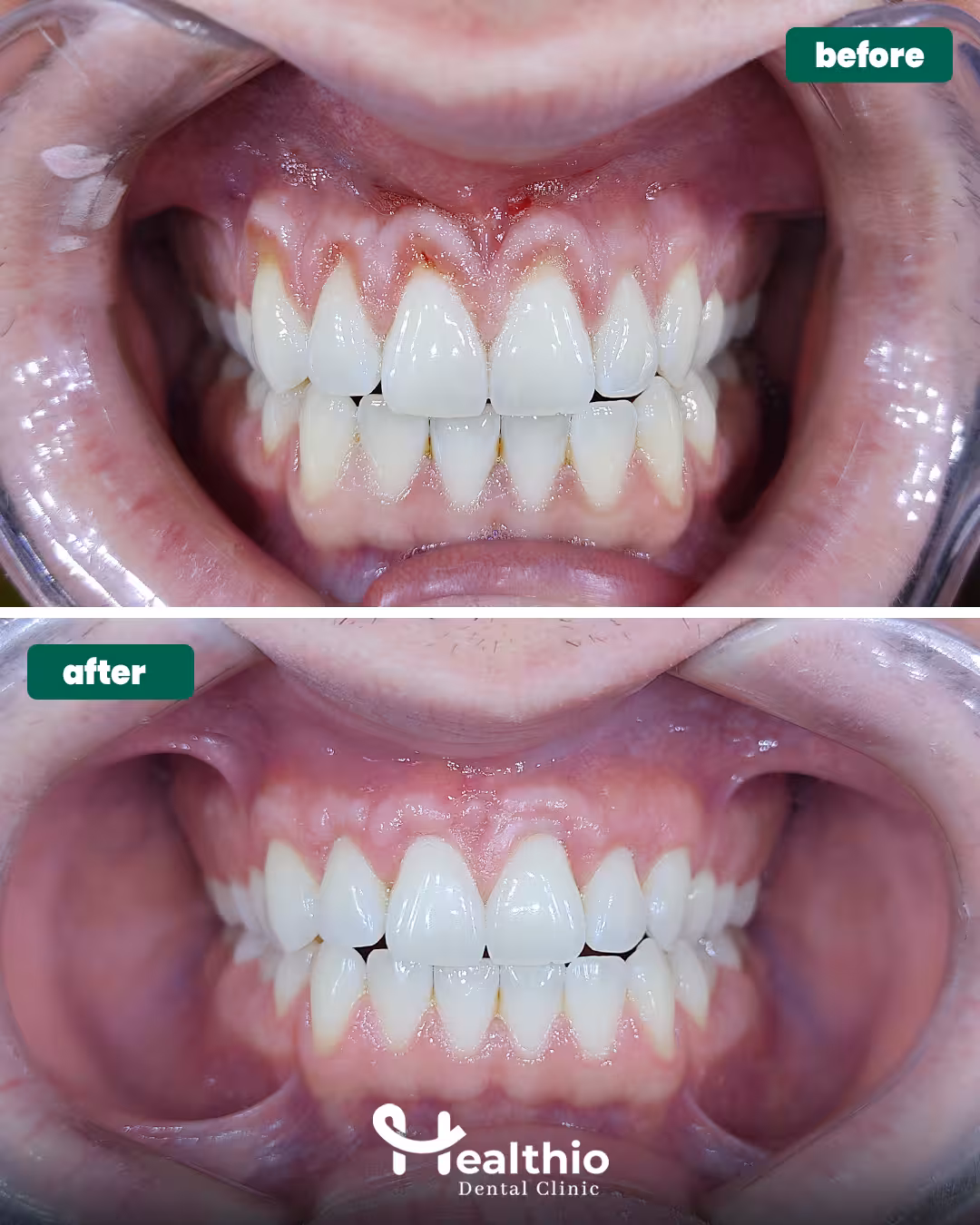 Dental Implants Turkey Before After
