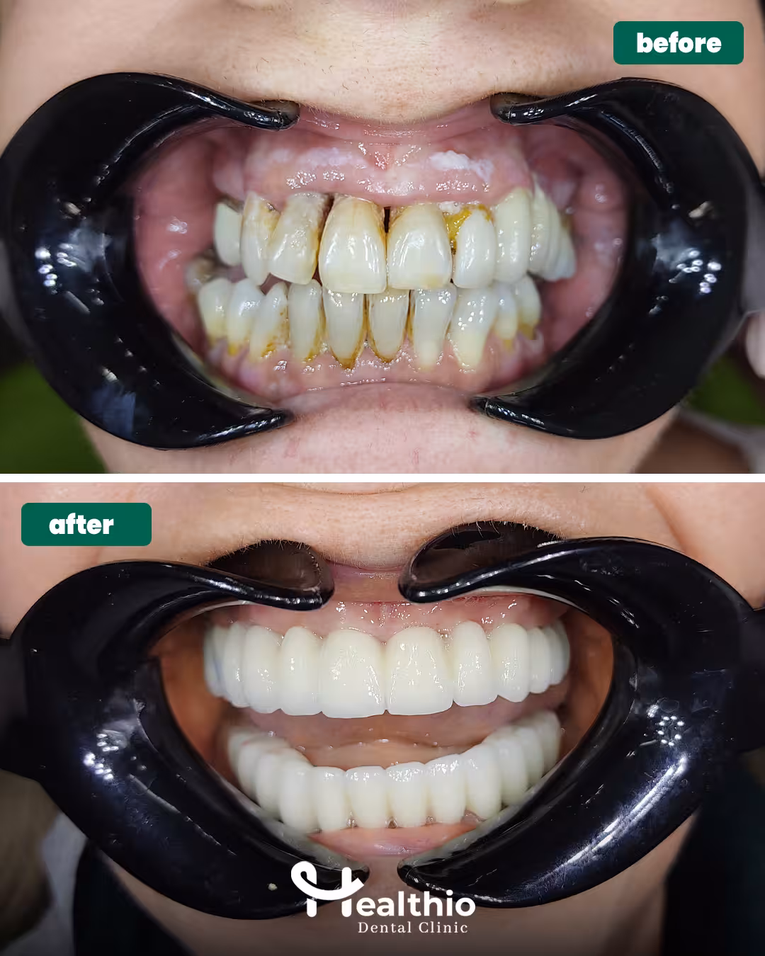 Veneers Turkey Before and after