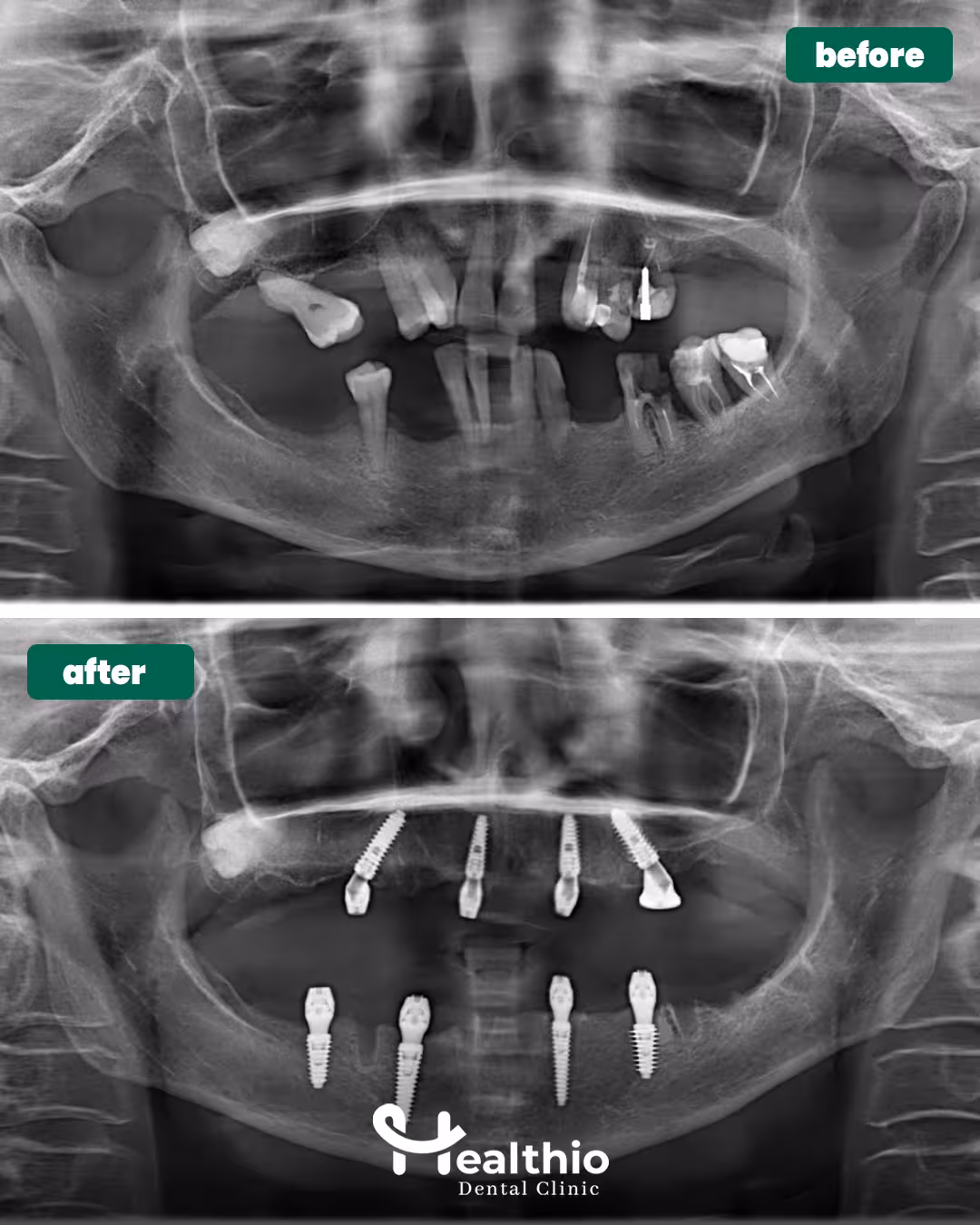 Veneers Turkey Before and after