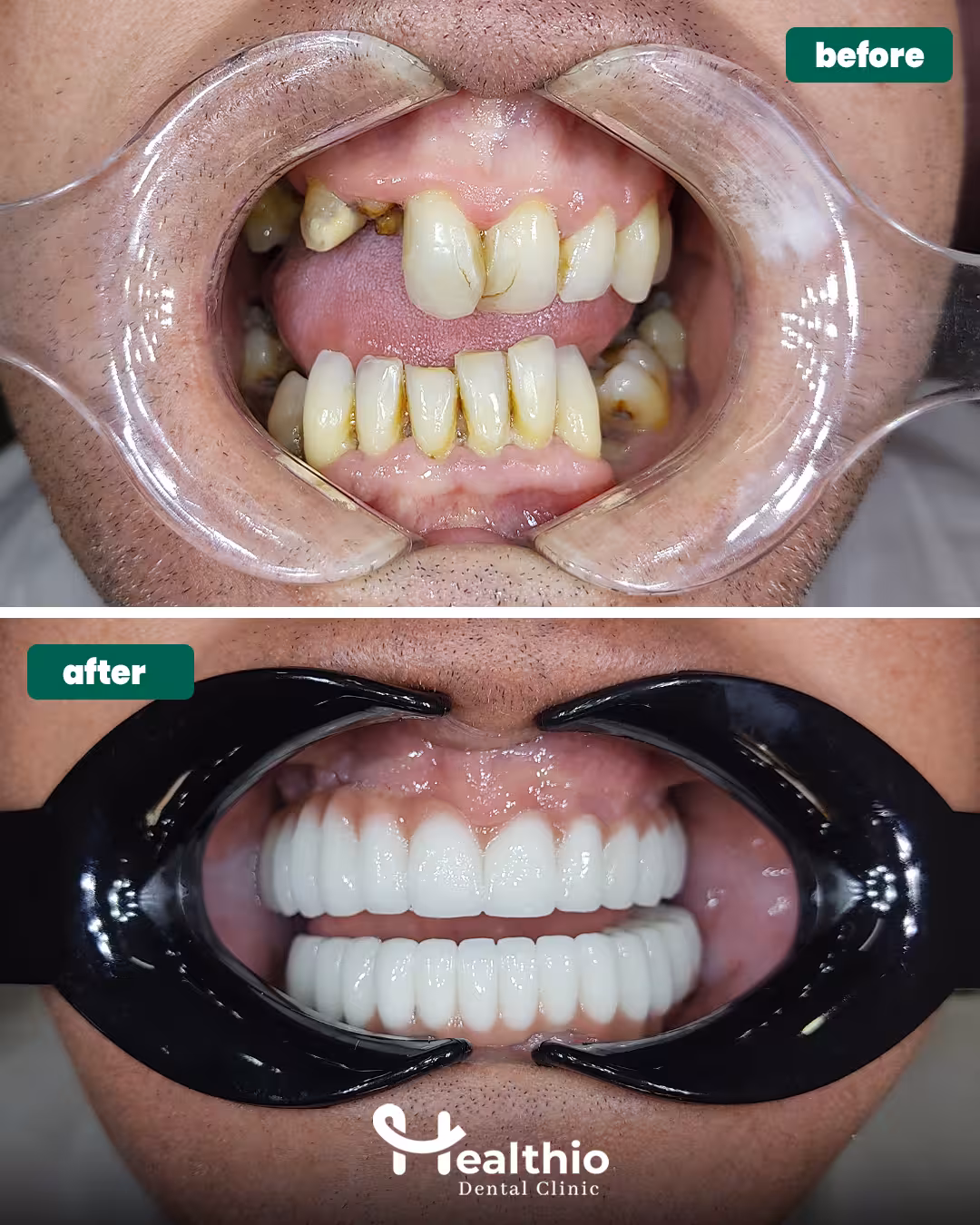 smile makeover before and after