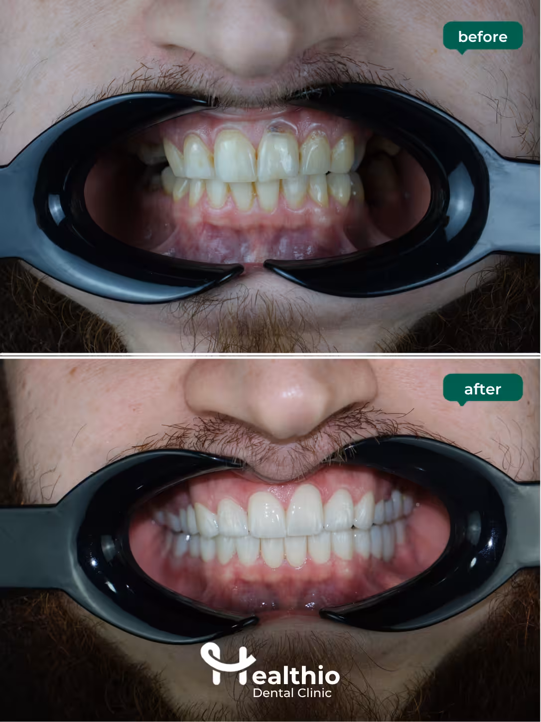 Dental crown before and after result in Antalya – Case 10
