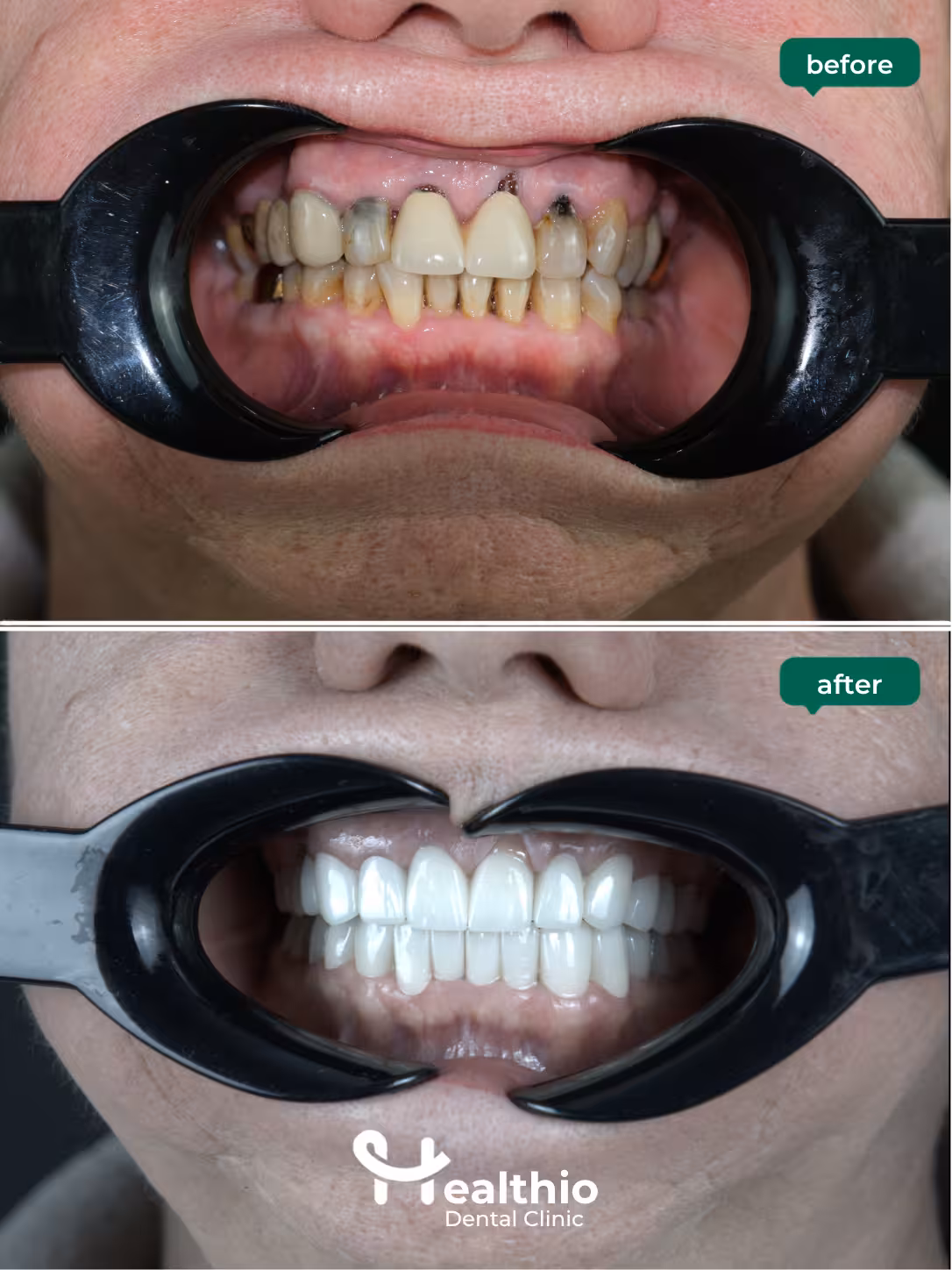 Dental crown before and after result in Antalya – Case 11