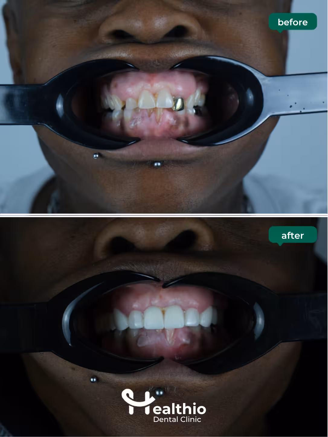 Dental crown before and after result in Antalya – Case 12