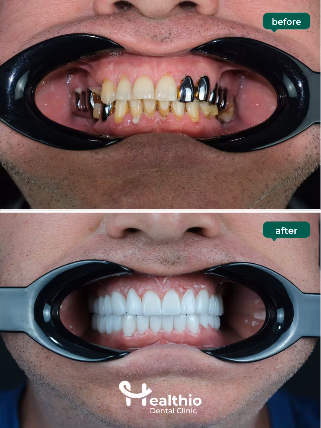 Dental crown before and after result in Antalya – Case 13