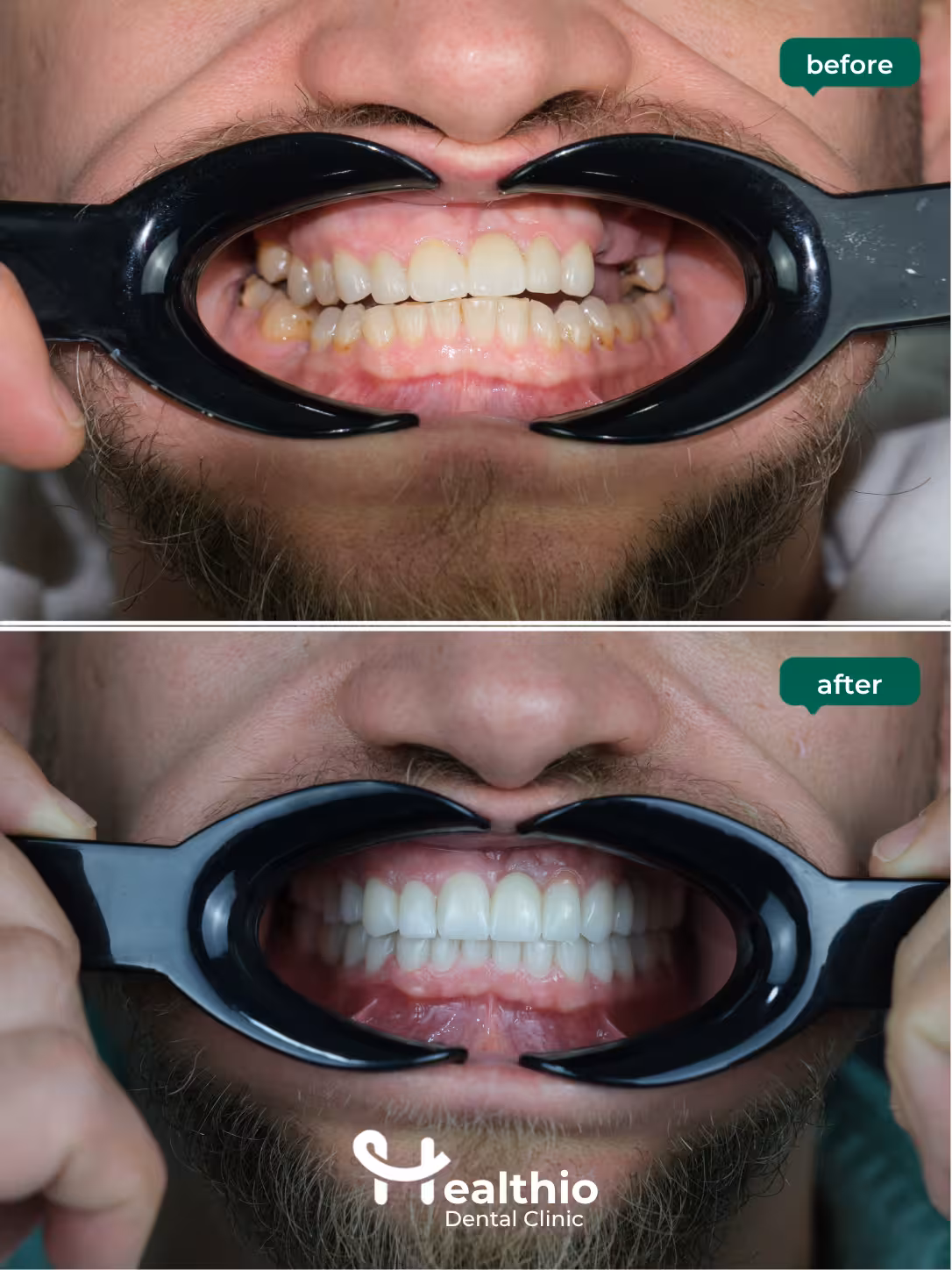 Dental crown before and after result in Antalya – Case 14