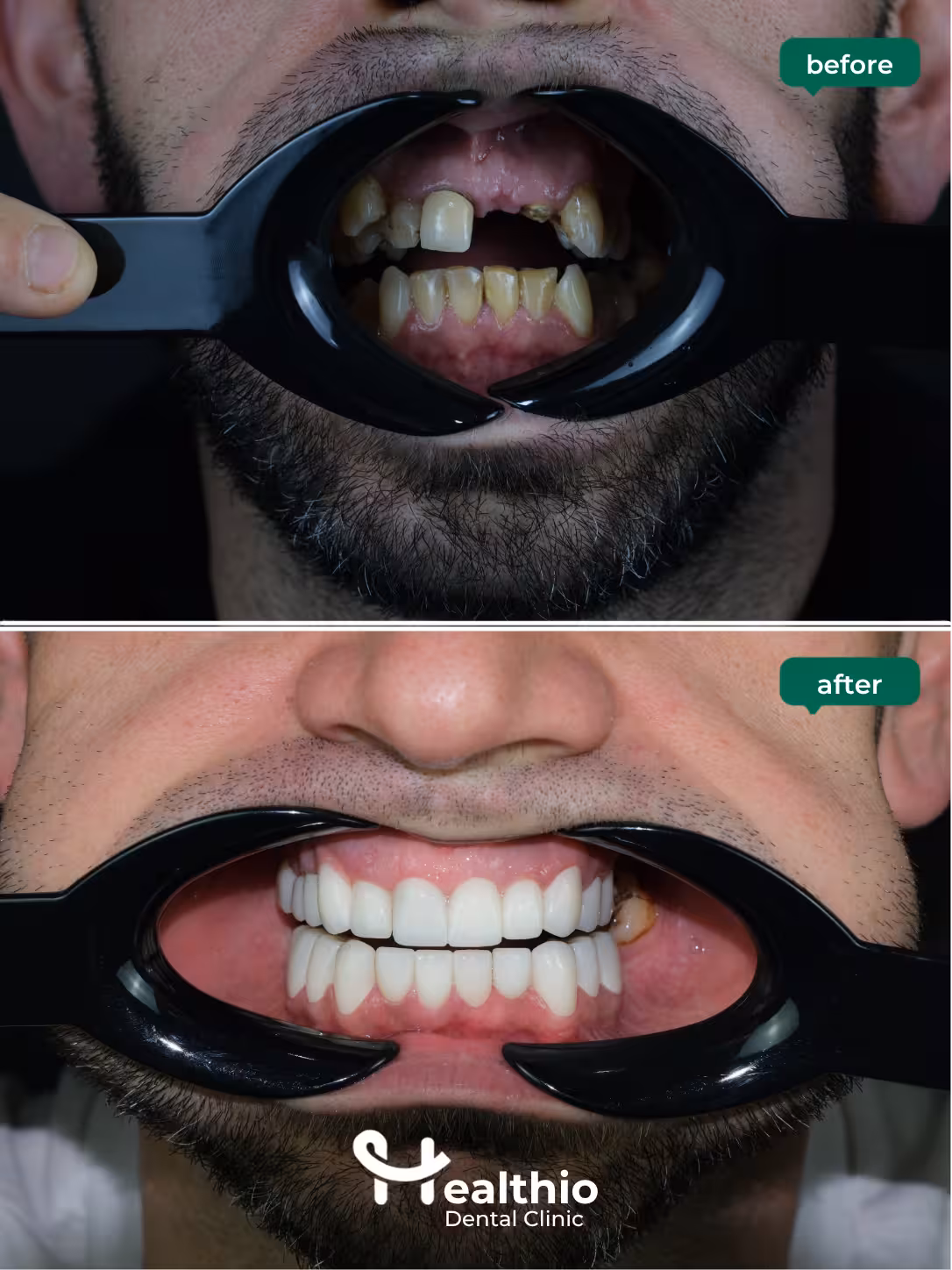Dental crown before and after result in Antalya – Case 15