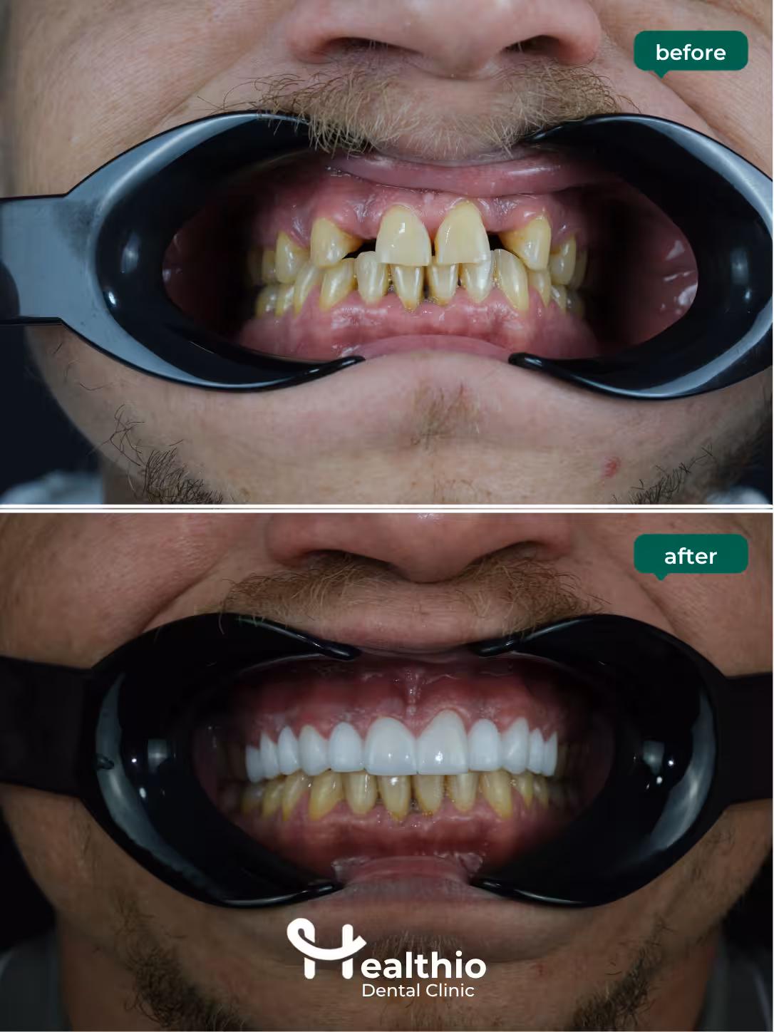 Dental crown before and after result in Antalya – Case 16