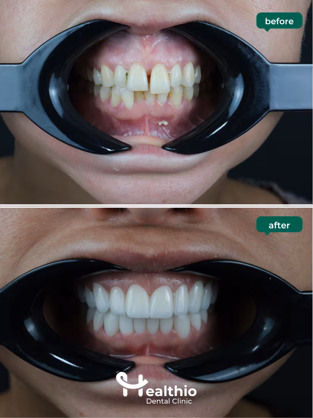 Dental crown before and after result in Antalya – Case 17