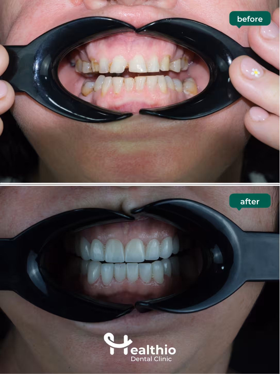 Dental crown before and after result in Antalya – Case 18