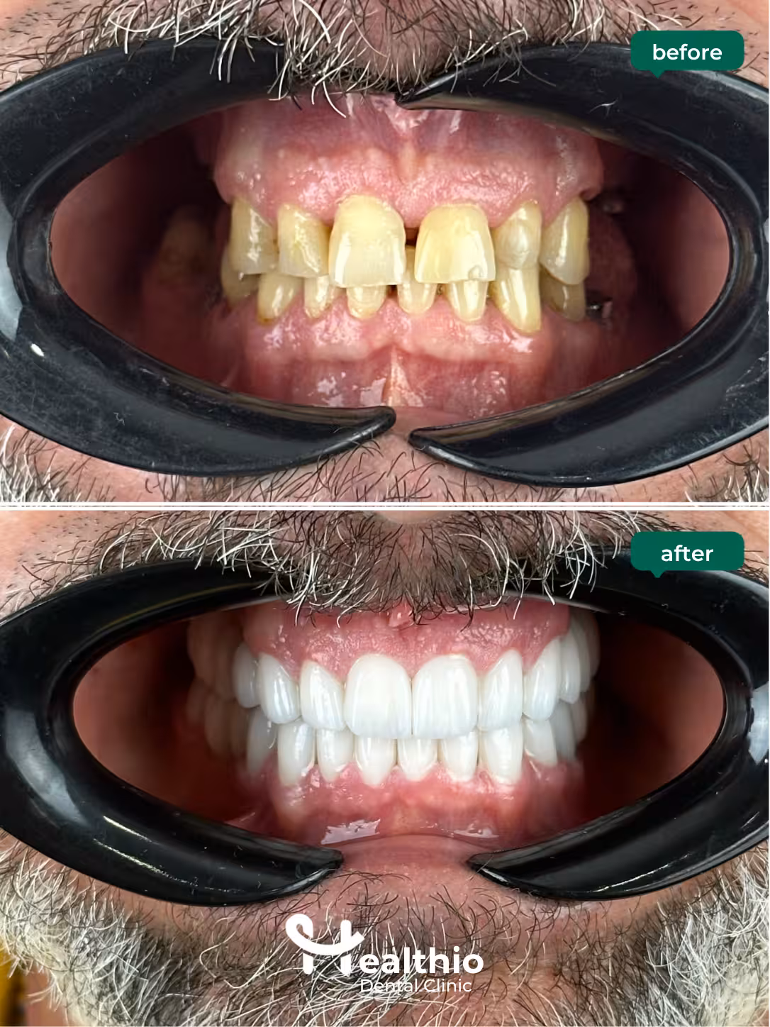 Dental crown before and after result in Antalya – Case 19