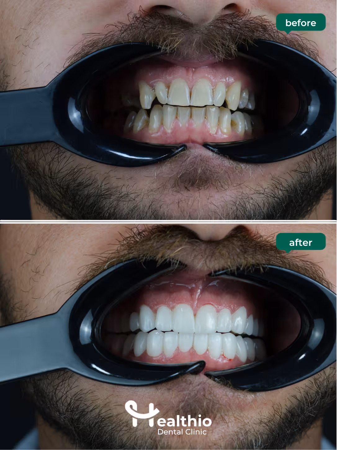 Dental crown before and after result in Antalya – Case 2