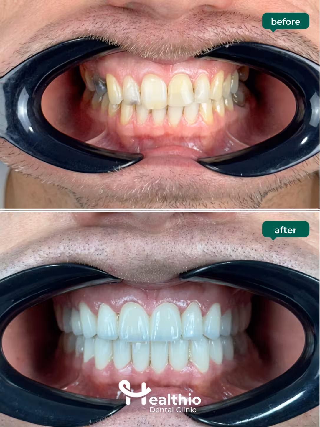 Dental crown before and after result in Antalya – Case 20