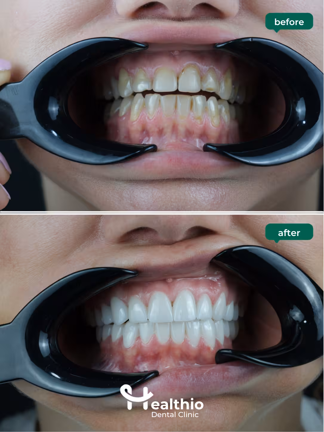 Dental crown before and after result in Antalya – Case 3