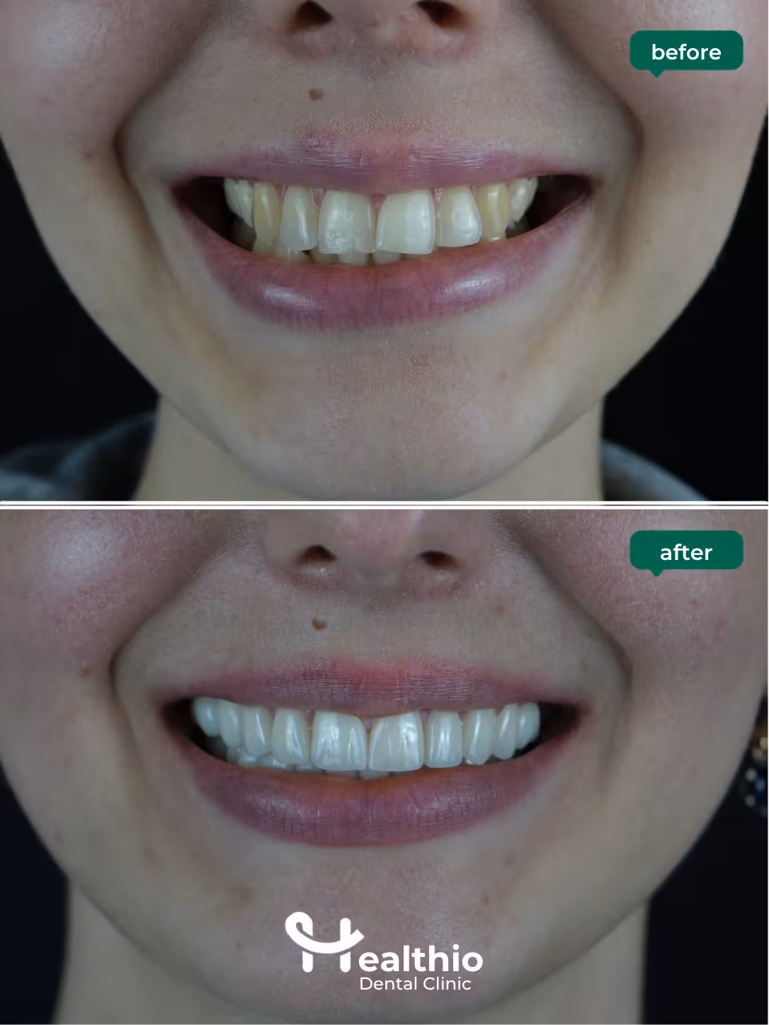 Dental crown before and after result in Antalya – Case 4
