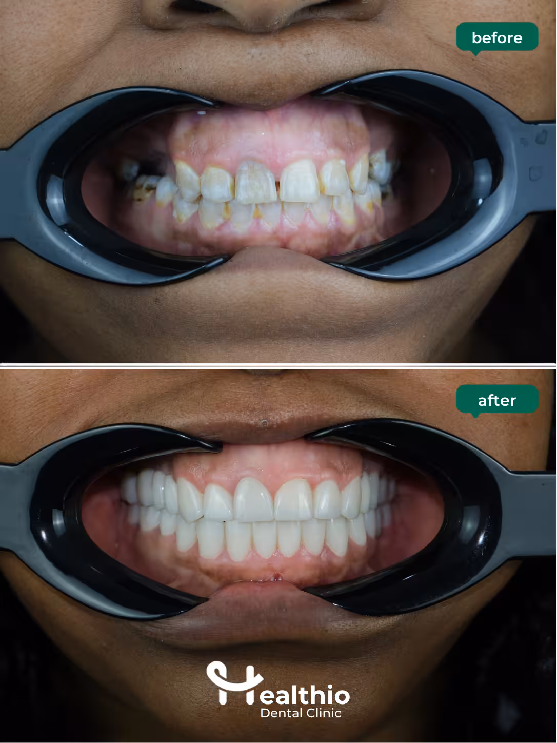 Dental crown before and after result in Antalya – Case 5