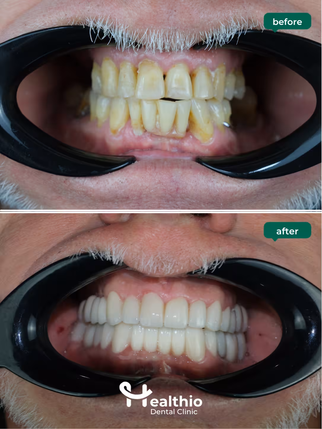 Dental crown before and after result in Antalya – Case 6