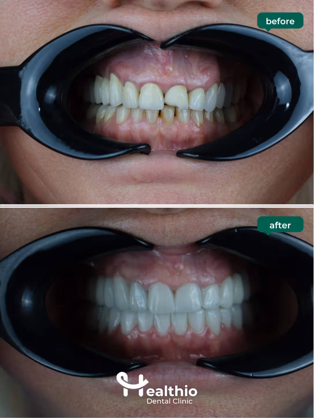 Dental crown before and after result in Antalya – Case 7