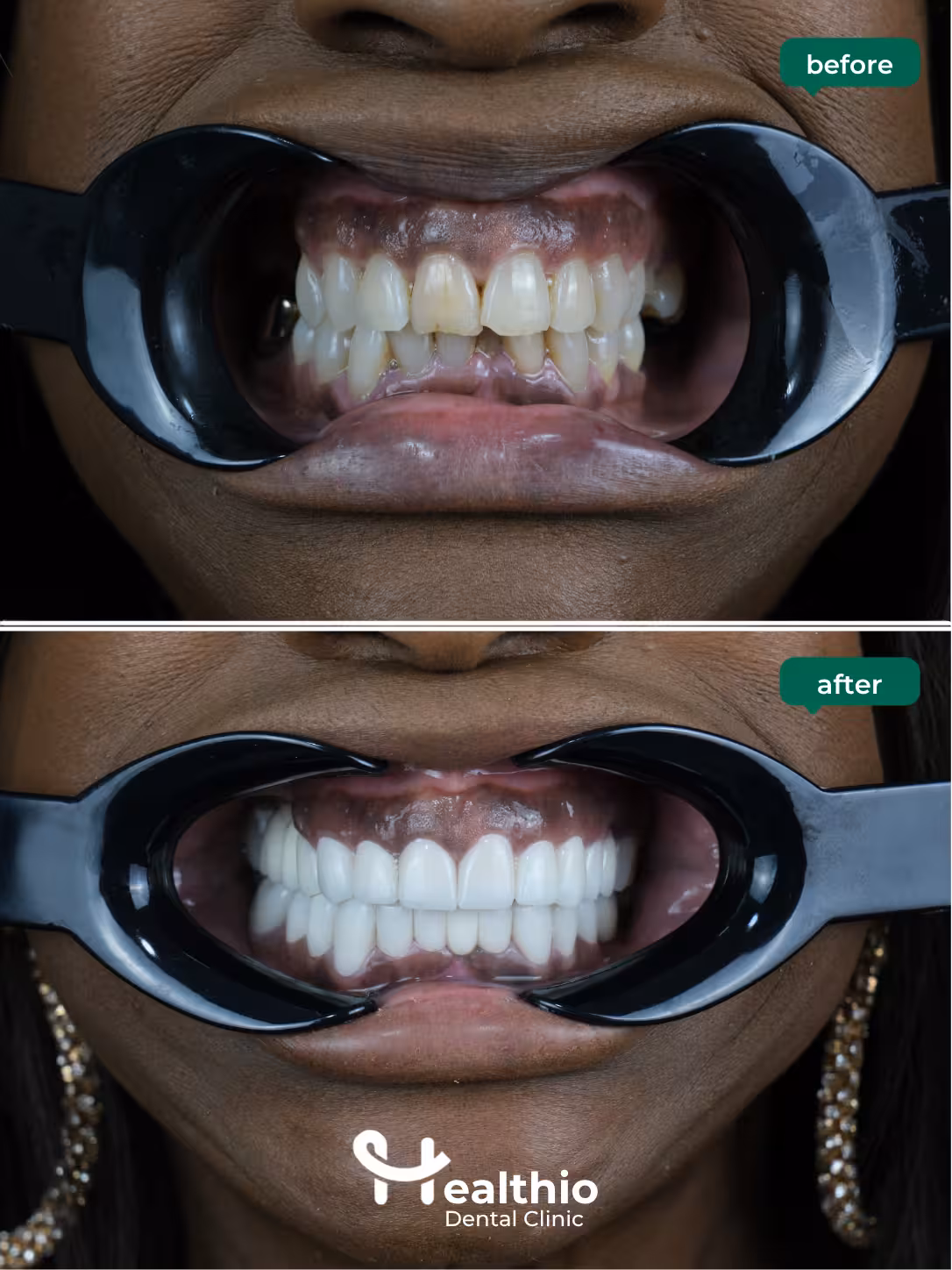 Dental crown before and after result in Antalya – Case 8