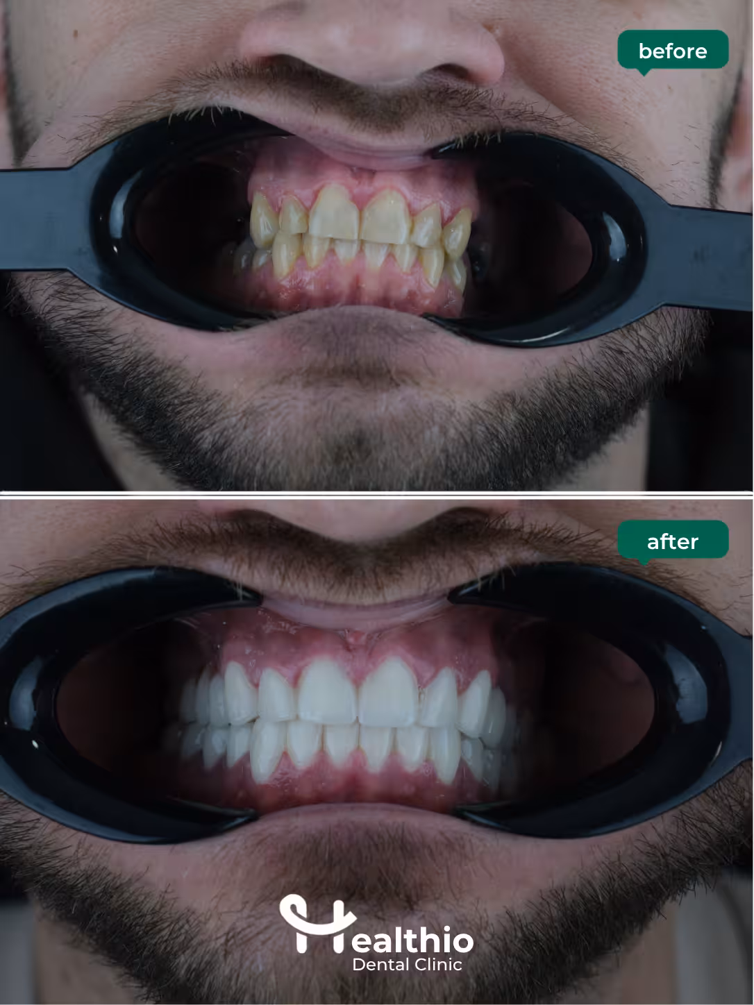Dental crown before and after result in Antalya – Case 9