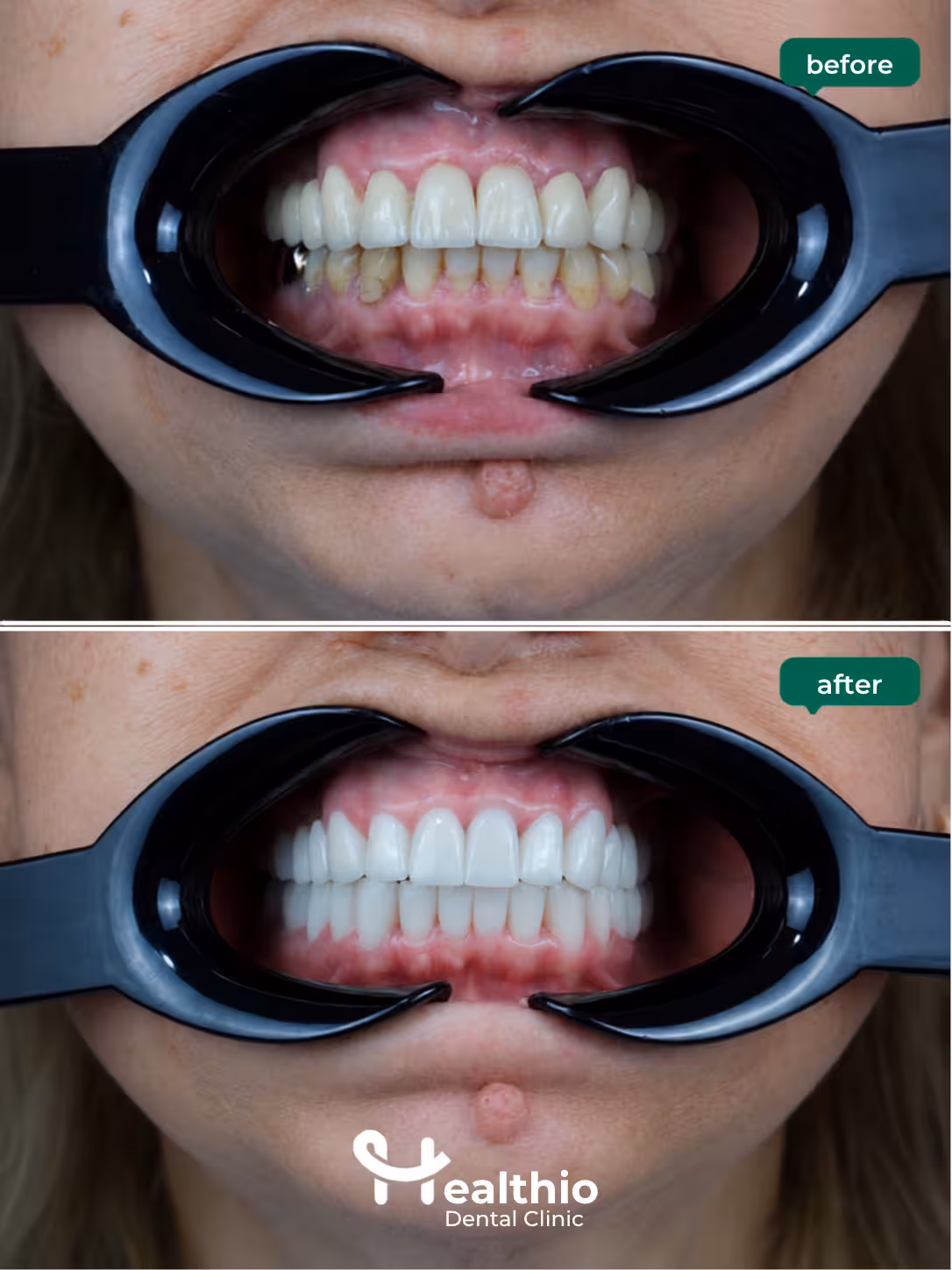 Dental crown before and after result in Antalya – Case 1