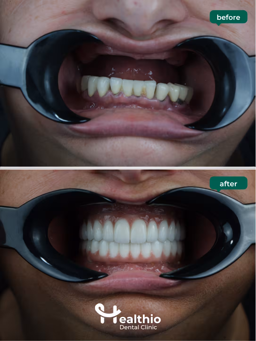 Dental implant before and after result in Antalya – Case 5