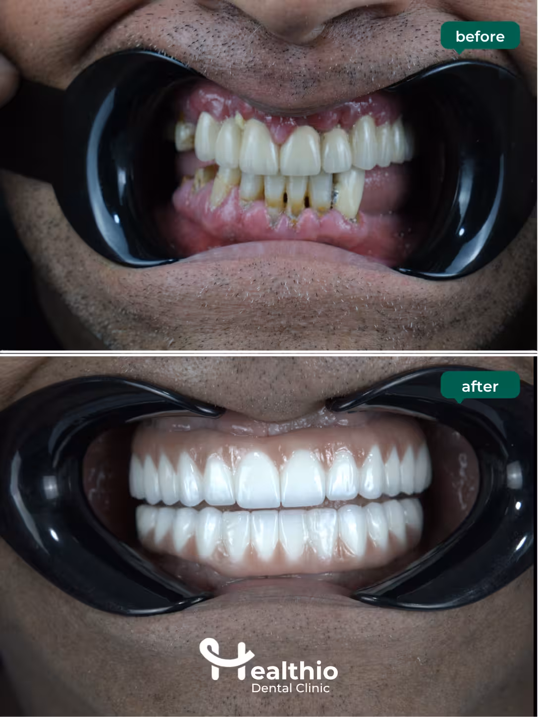 Dental implant before and after result in Antalya – Case 4