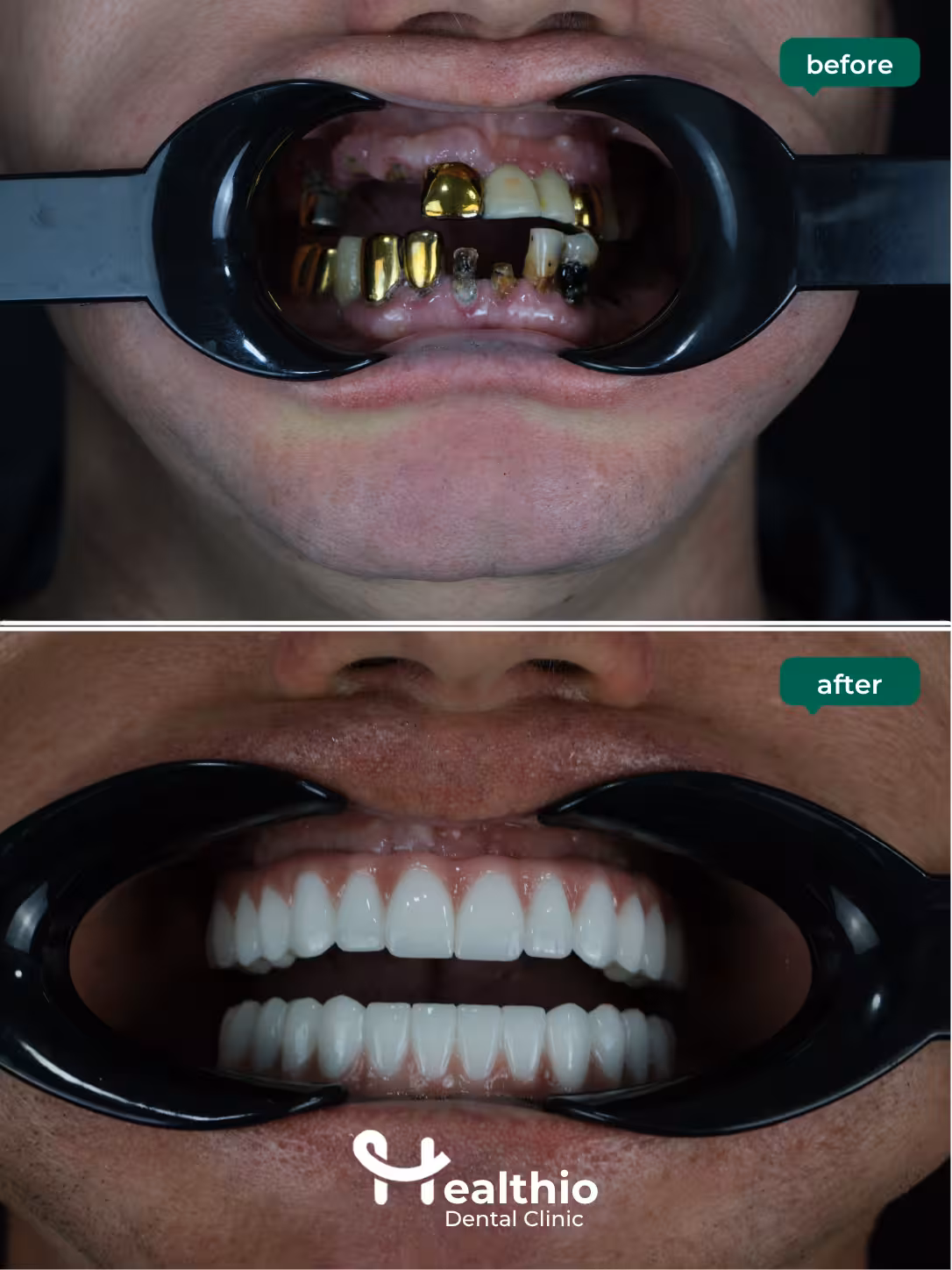 Dental implant before and after result in Antalya – Case 3