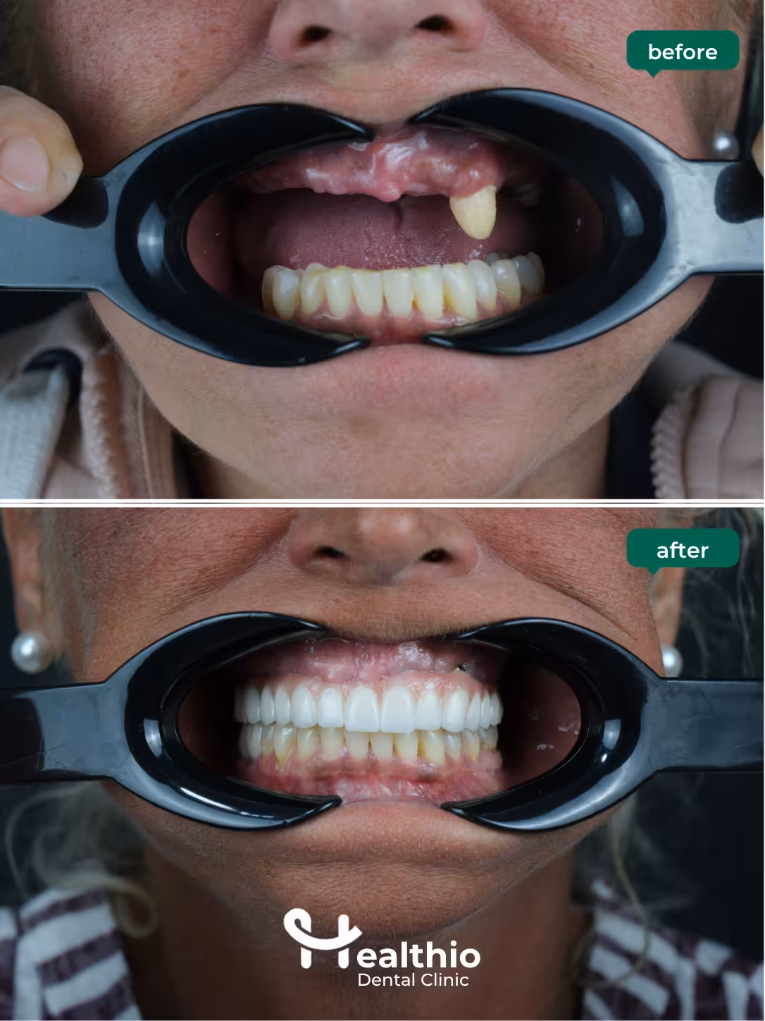 Dental implant before and after result in Antalya – Case 2