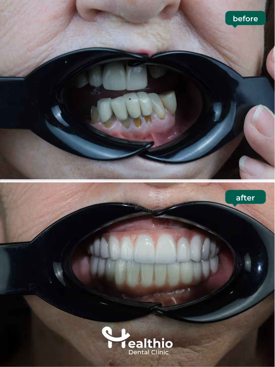 Dental implant before and after result in Antalya – Case 1