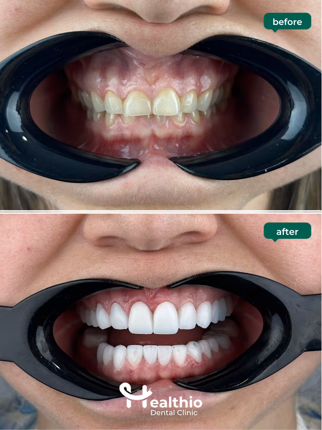 Laminate veneers before and after result in Antalya – Case 1