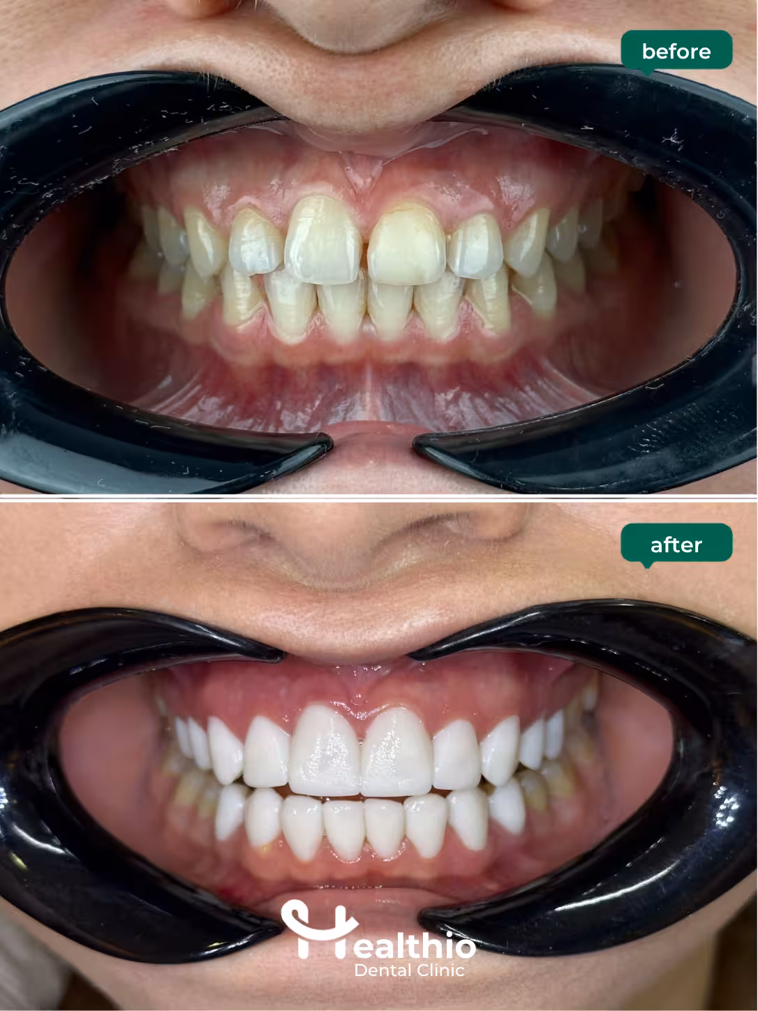 Laminate veneers before and after result in Antalya – Case 2
